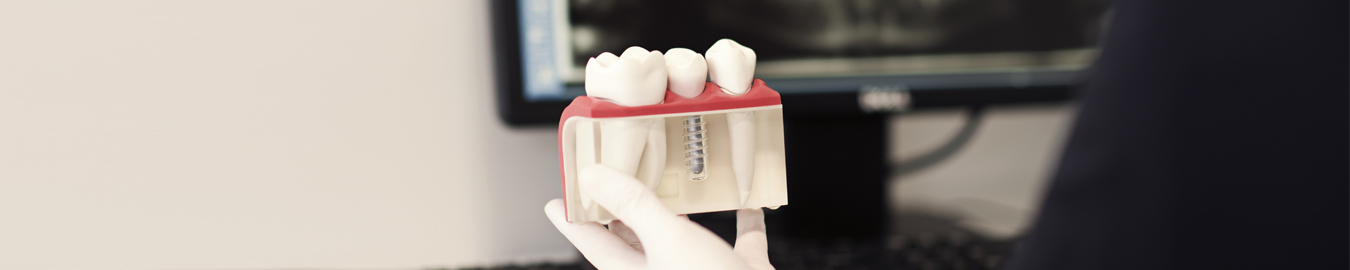 Dantų implantai ir implantacija